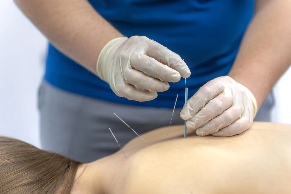 Acupuntura